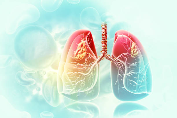 Долгая жизнь: как регулярные обследования помогают победить рак лёгкого